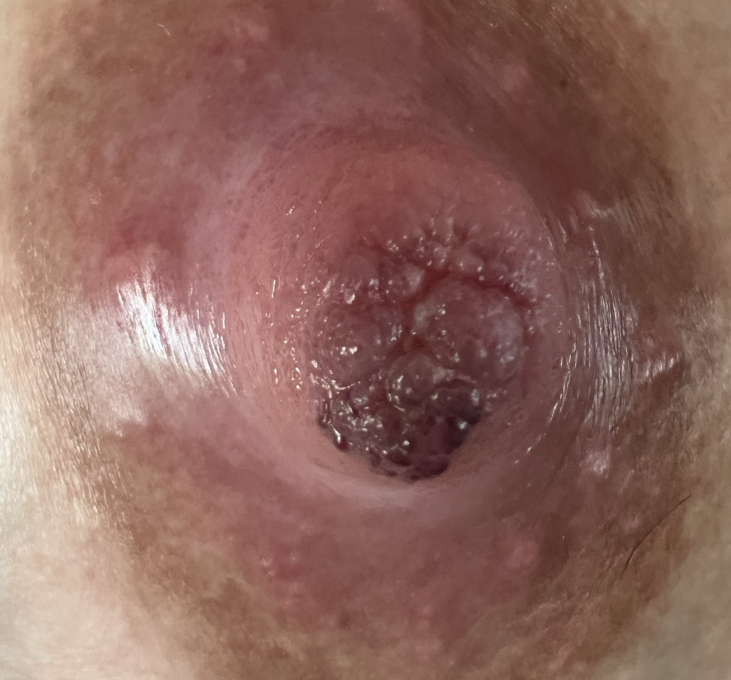 Pump suction trauma left nipple